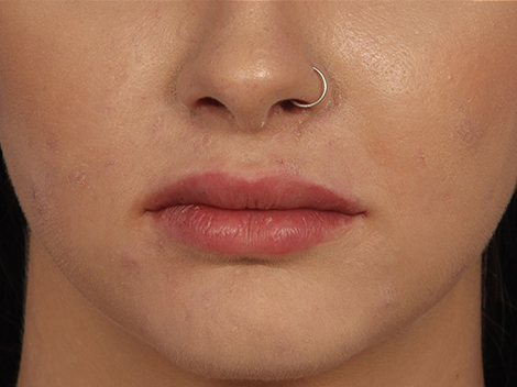 Lip Augmentation before and after photo