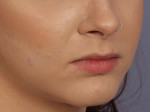 Lip Augmentation Before and after photo