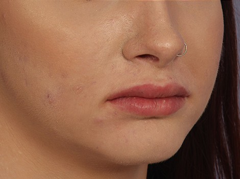 Lip Augmentation before and after photo