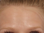 BOTOX® Cosmetic Before and after photo