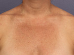 Laser Skin Resurfacing Before and after photo