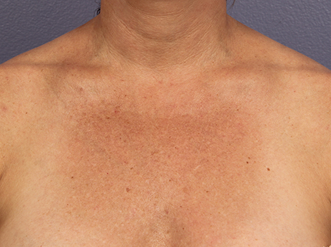 Laser Skin Resurfacing before and after photo