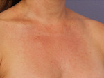 Laser Skin Resurfacing Before and after photo