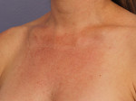 Laser Skin Resurfacing Before and after photo