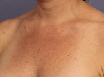 Laser Skin Resurfacing Before and after photo