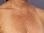 Laser Skin Resurfacing Before and after photo