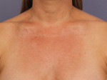 Laser Skin Resurfacing Before and after photo