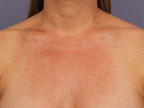 Laser Skin Resurfacing before and after photo