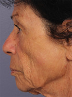 Medical Spa Services Before and after photo