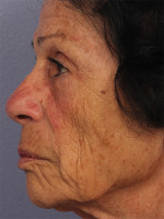 Medical Spa Services Before and after photo