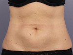 CoolSculpting® Before and after photo