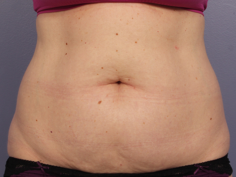 CoolSculpting® before and after photo