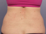 CoolSculpting® Before and after photo