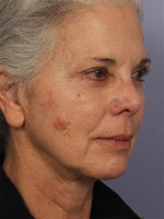 Medical Spa Services Before and after photo