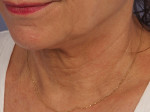 Ultherapy Before and after photo