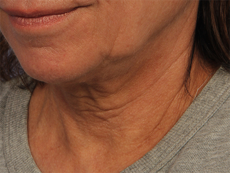 Ultherapy before and after photo