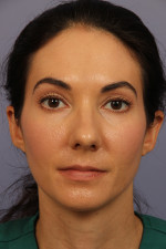 Nose Reshaping Before and after photo