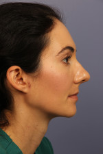 Nose Reshaping