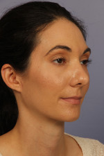 Nose Reshaping Before and after photo