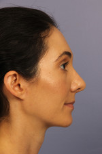 Nose Reshaping Before and after photo