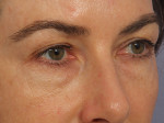 Injectable Fillers Before and after photo