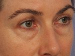 Injectable Fillers Before and after photo