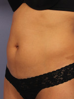 CoolSculpting® Before and after photo