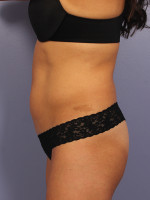 CoolSculpting® Before and after photo