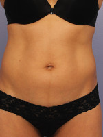 CoolSculpting® Before and after photo