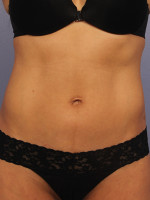 CoolSculpting® Before and after photo