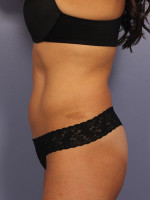 CoolSculpting® Before and after photo