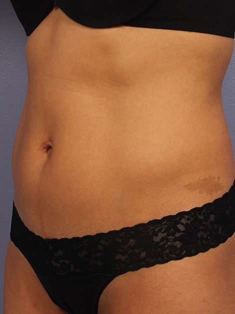 CoolSculpting® before and after photo