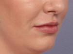 Lip Augmentation Before and after photo