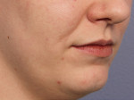 Lip Augmentation