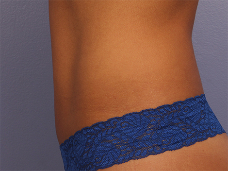 CoolSculpting® before and after photo