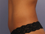 CoolSculpting® Before and after photo