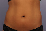 CoolSculpting® Before and after photo