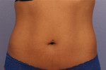 CoolSculpting® Before and after photo