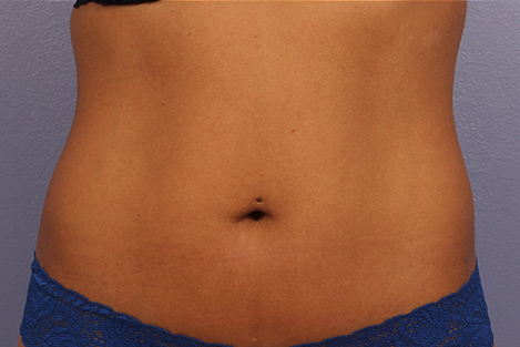 CoolSculpting® before and after photo