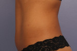 CoolSculpting® Before and after photo