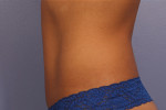 CoolSculpting® Before and after photo