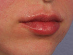 Lip Augmentation Before and after photo