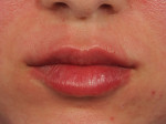 Lip Augmentation Before and after photo