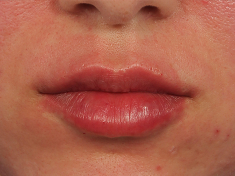 Lip Augmentation before and after photo
