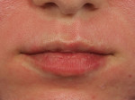 Lip Augmentation Before and after photo