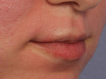 Lip Augmentation Before and after photo