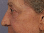 Laser Skin Resurfacing Before and after photo