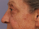 Laser Skin Resurfacing Before and after photo