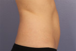 CoolSculpting® Before and after photo