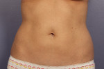 CoolSculpting® Before and after photo